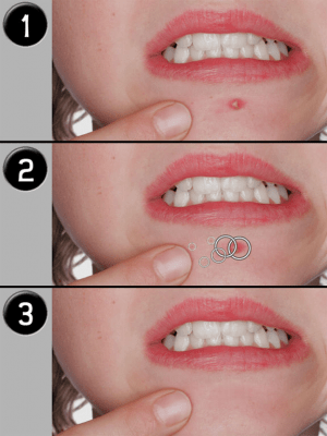 Скриншот приложения Pimple Eraser LITE - №2
